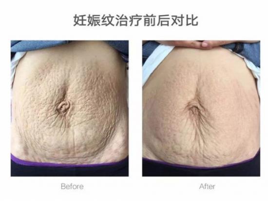 碧无痕娠纹修复