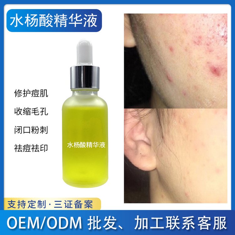 水杨酸原液祛痘去闭口粉刺收缩毛孔黑头痘印精华液厂家半成品批发